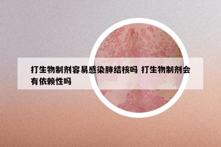 打生物制剂容易感染肺结核吗 打生物制剂会有依赖性吗