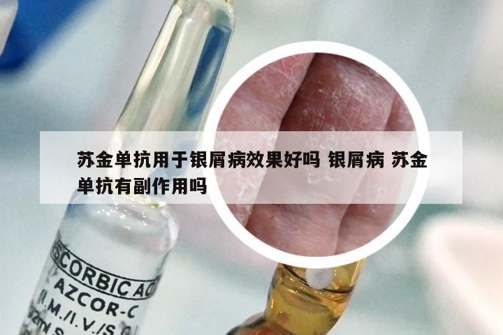 苏金单抗用于银屑病效果好吗 银屑病 苏金单抗有副作用吗