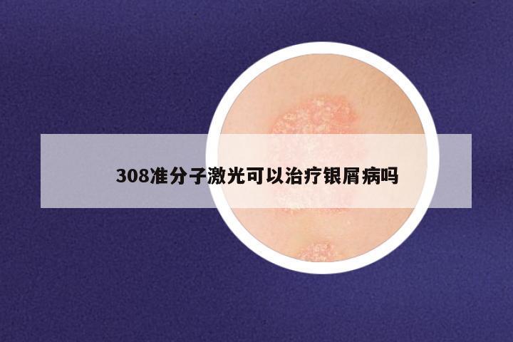 308准分子激光可以治疗银屑病吗