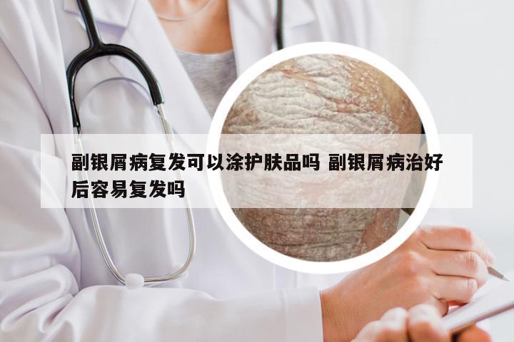 副银屑病复发可以涂护肤品吗 副银屑病治好后容易复发吗