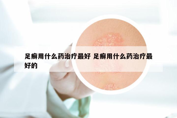 足癣用什么药治疗最好 足癣用什么药治疗最好的