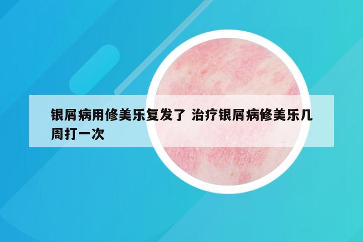 银屑病用修美乐复发了 治疗银屑病修美乐几周打一次