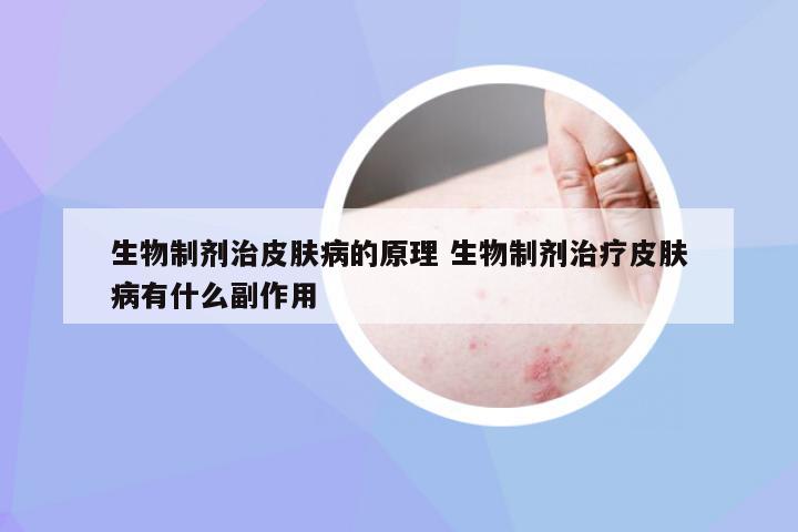 生物制剂治皮肤病的原理 生物制剂治疗皮肤病有什么副作用