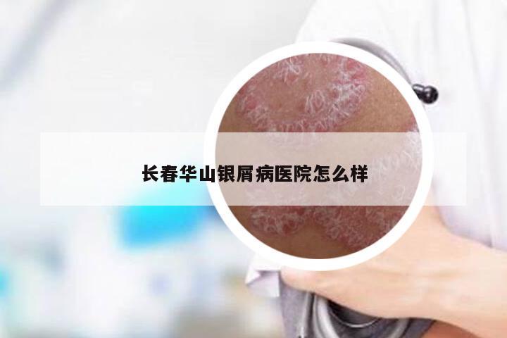 长春华山银屑病医院怎么样