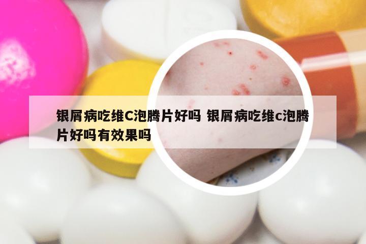 银屑病吃维C泡腾片好吗 银屑病吃维c泡腾片好吗有效果吗