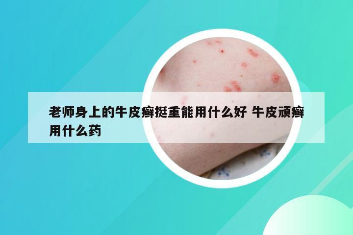 老师身上的牛皮癣挺重能用什么好 牛皮顽癣用什么药