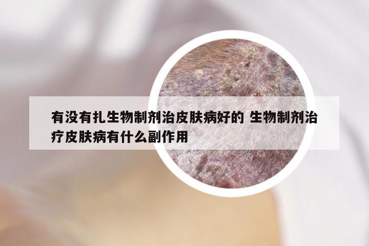 有没有扎生物制剂治皮肤病好的 生物制剂治疗皮肤病有什么副作用