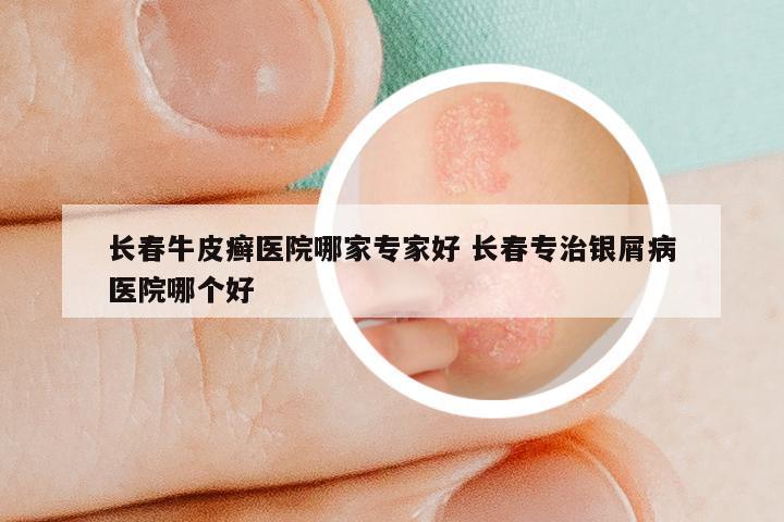 长春牛皮癣医院哪家专家好 长春专治银屑病医院哪个好