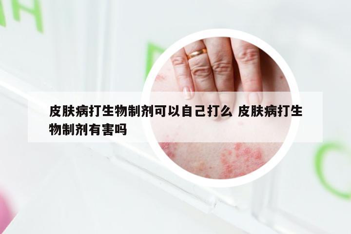 皮肤病打生物制剂可以自己打么 皮肤病打生物制剂有害吗