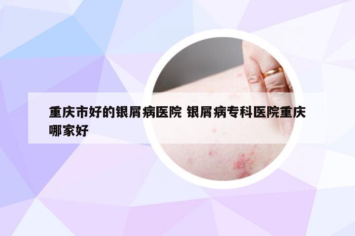 重庆市好的银屑病医院 银屑病专科医院重庆哪家好