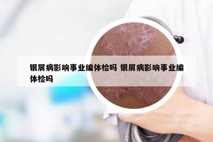 银屑病影响事业编体检吗 银屑病影响事业编体检吗