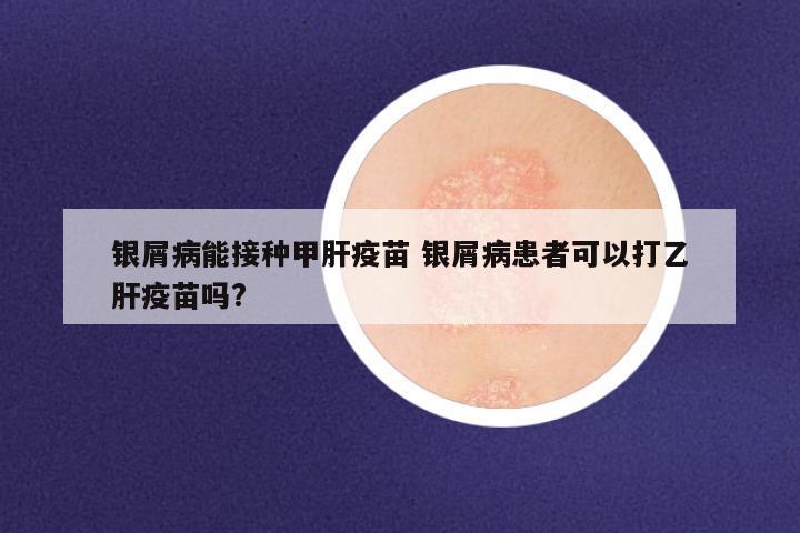 银屑病能接种甲肝疫苗 银屑病患者可以打乙肝疫苗吗?