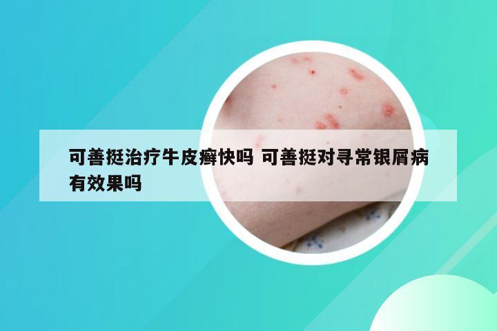 可善挺治疗牛皮癣快吗 可善挺对寻常银屑病有效果吗