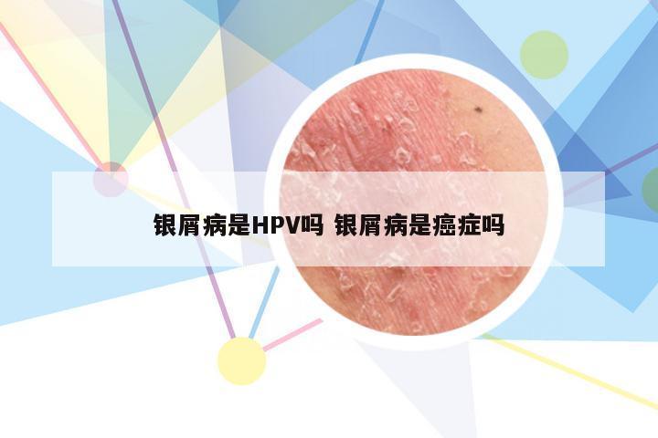 银屑病是HPV吗 银屑病是癌症吗