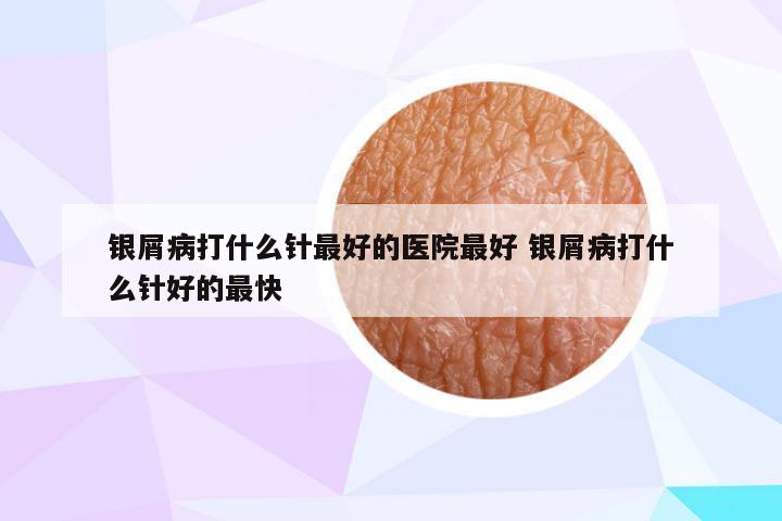 银屑病打什么针最好的医院最好 银屑病打什么针好的最快