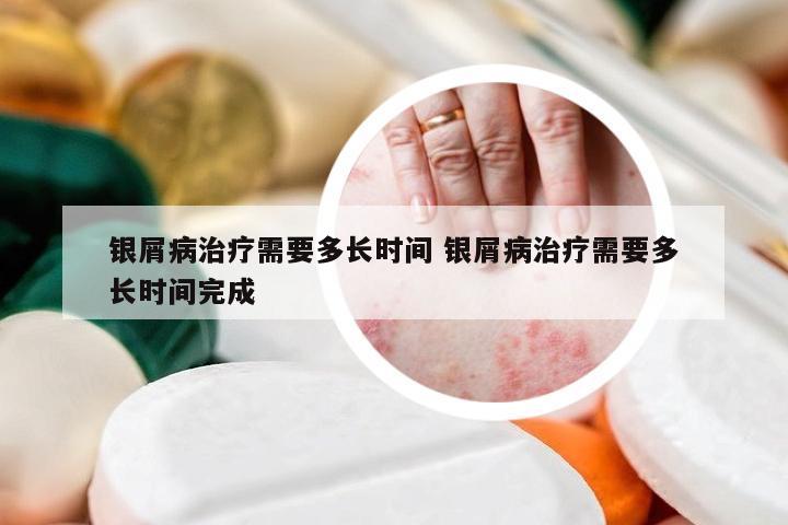 银屑病治疗需要多长时间 银屑病治疗需要多长时间完成