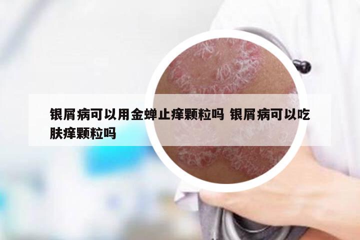 银屑病可以用金蝉止痒颗粒吗 银屑病可以吃肤痒颗粒吗