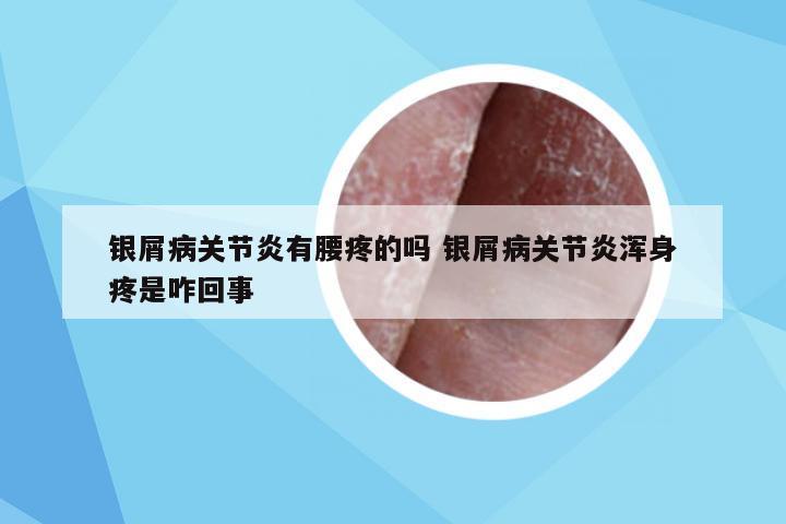 银屑病关节炎有腰疼的吗 银屑病关节炎浑身疼是咋回事