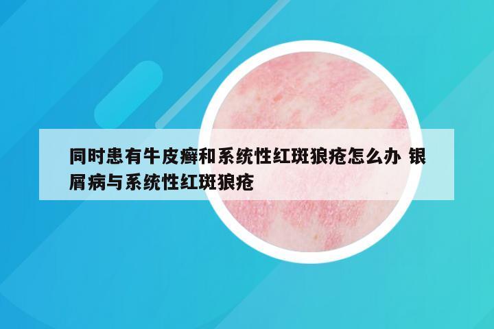 同时患有牛皮癣和系统性红斑狼疮怎么办 银屑病与系统性红斑狼疮