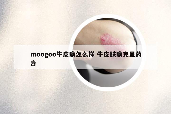 moogoo牛皮癣怎么样 牛皮肤癣克星药膏