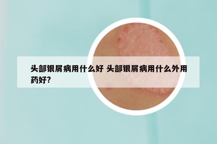 头部银屑病用什么好 头部银屑病用什么外用药好?