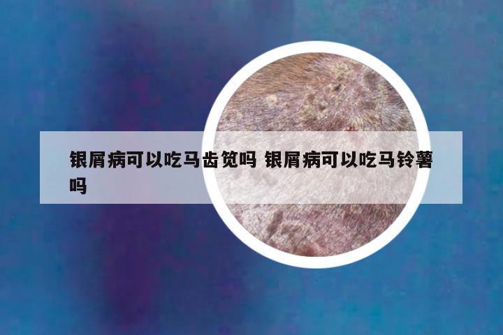 银屑病可以吃马齿笕吗 银屑病可以吃马铃薯吗