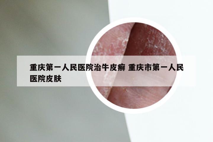 重庆第一人民医院治牛皮癣 重庆市第一人民医院皮肤