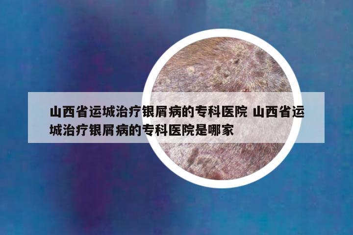 山西省运城治疗银屑病的专科医院 山西省运城治疗银屑病的专科医院是哪家