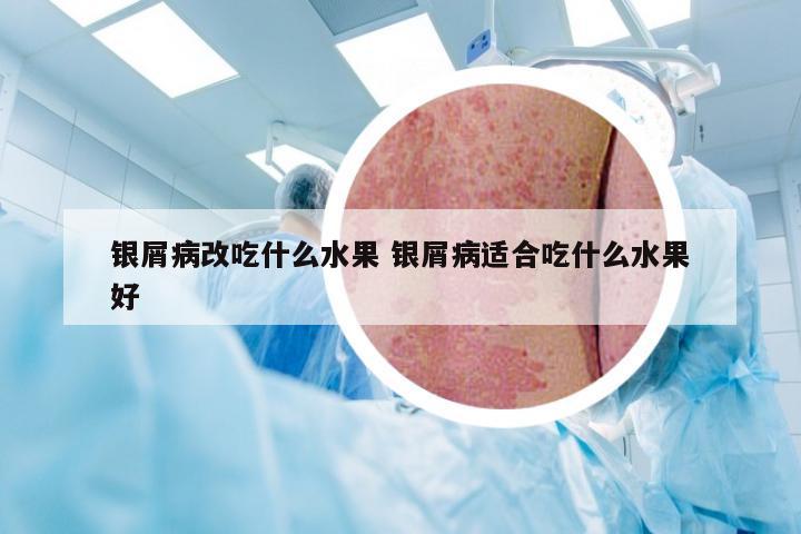 银屑病改吃什么水果 银屑病适合吃什么水果好