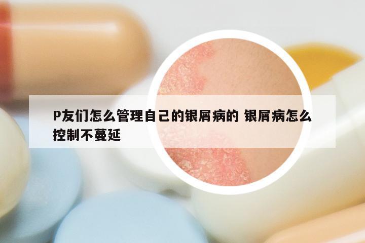 P友们怎么管理自己的银屑病的 银屑病怎么控制不蔓延