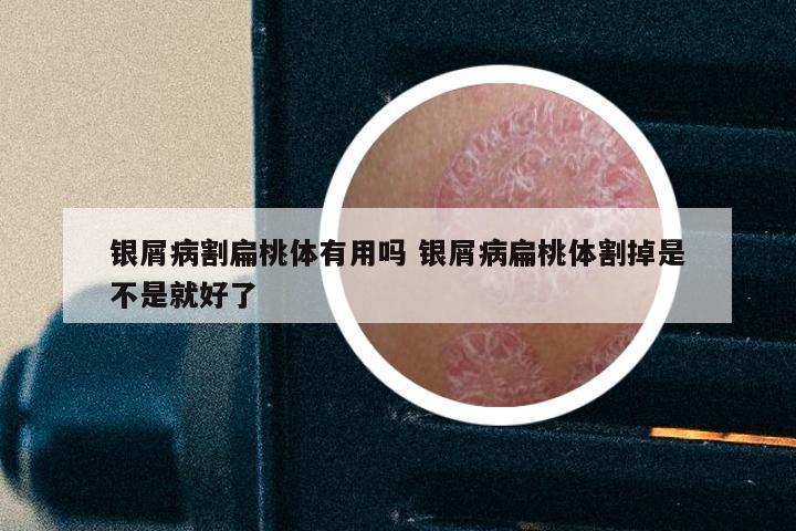 银屑病割扁桃体有用吗 银屑病扁桃体割掉是不是就好了