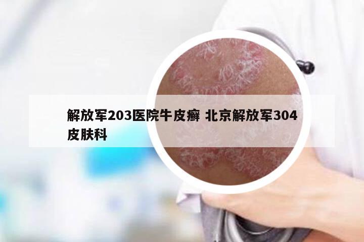 解放军203医院牛皮癣 北京解放军304皮肤科