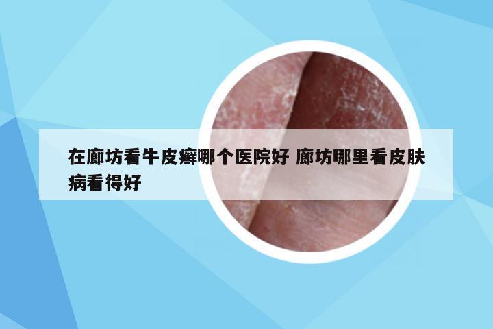 在廊坊看牛皮癣哪个医院好 廊坊哪里看皮肤病看得好