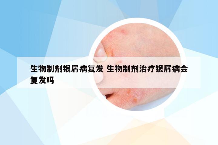 生物制剂银屑病复发 生物制剂治疗银屑病会复发吗