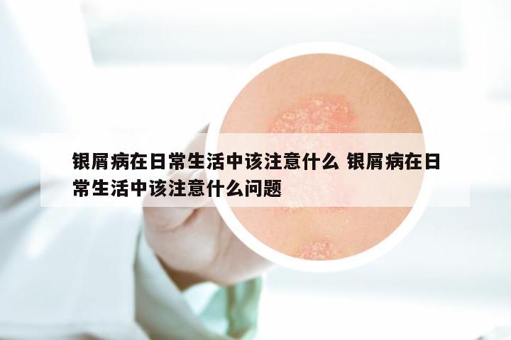 银屑病在日常生活中该注意什么 银屑病在日常生活中该注意什么问题