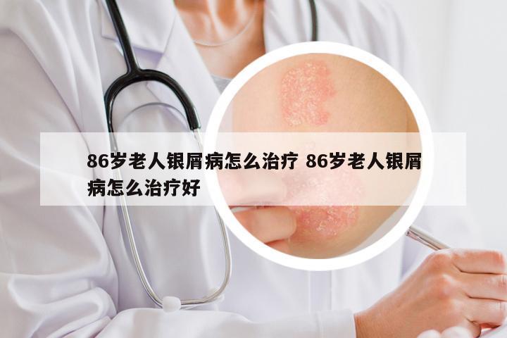 86岁老人银屑病怎么治疗 86岁老人银屑病怎么治疗好