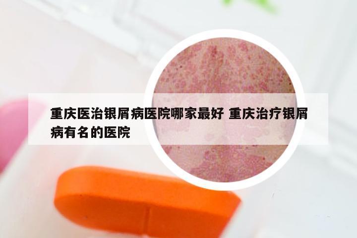 重庆医治银屑病医院哪家最好 重庆治疗银屑病有名的医院