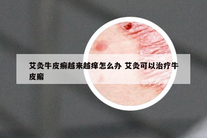 艾灸牛皮癣越来越痒怎么办 艾灸可以治疗牛皮廨