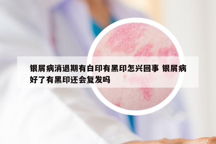 银屑病消退期有白印有黑印怎兴回事 银屑病好了有黑印还会复发吗