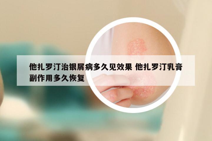 他扎罗汀治银屑病多久见效果 他扎罗汀乳膏副作用多久恢复