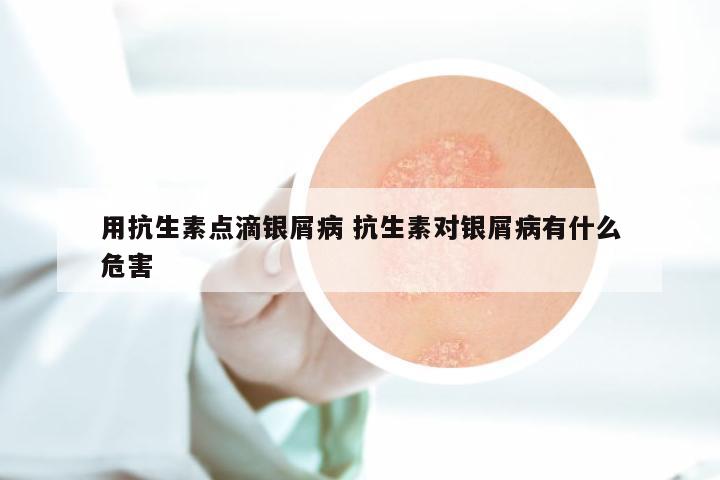 用抗生素点滴银屑病 抗生素对银屑病有什么危害