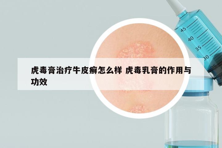 虎毒膏治疗牛皮癣怎么样 虎毒乳膏的作用与功效