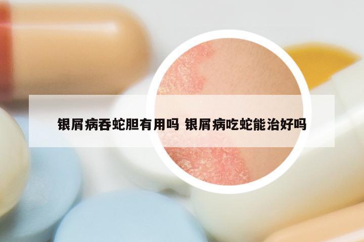 银屑病吞蛇胆有用吗 银屑病吃蛇能治好吗