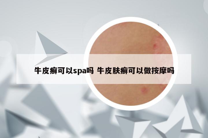 牛皮癣可以spa吗 牛皮肤癣可以做按摩吗