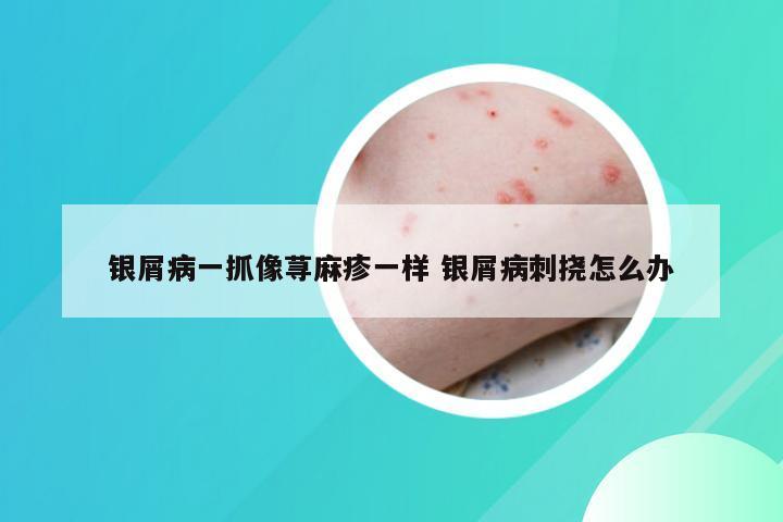 银屑病一抓像荨麻疹一样 银屑病刺挠怎么办