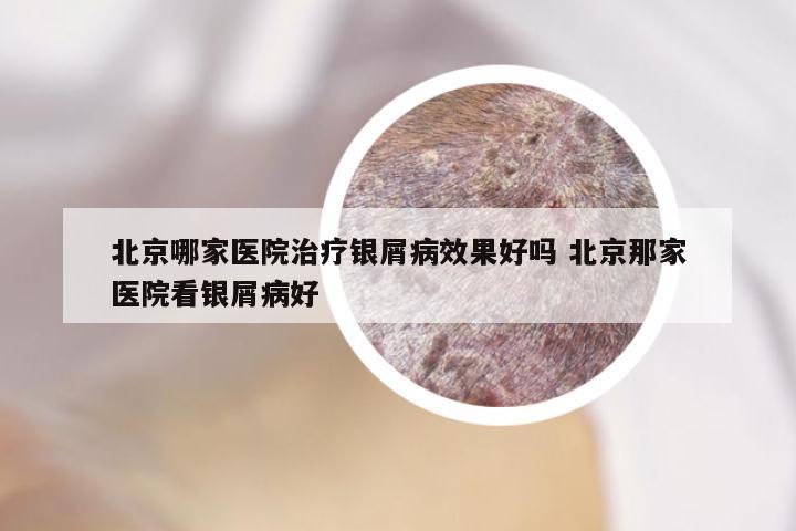 北京哪家医院治疗银屑病效果好吗 北京那家医院看银屑病好