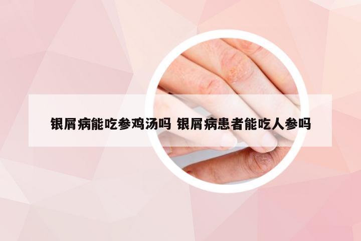 银屑病能吃参鸡汤吗 银屑病患者能吃人参吗