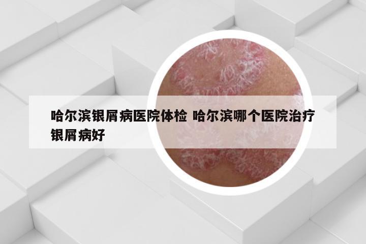 哈尔滨银屑病医院体检 哈尔滨哪个医院治疗银屑病好