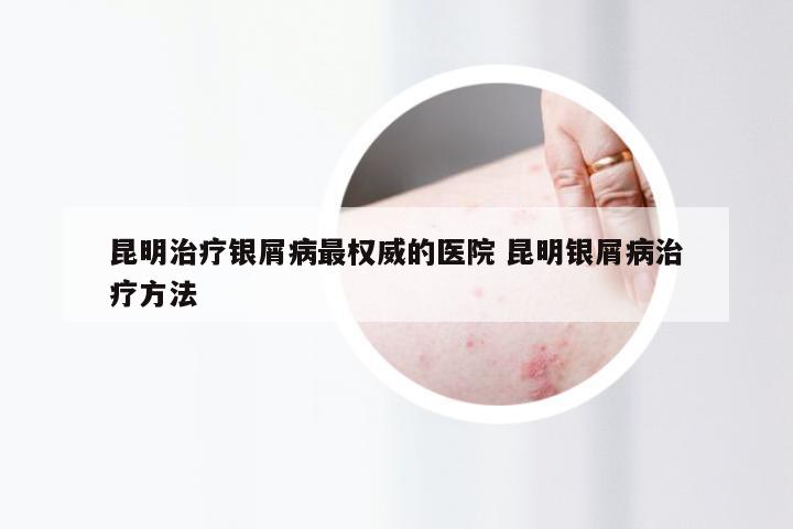 昆明治疗银屑病最权威的医院 昆明银屑病治疗方法