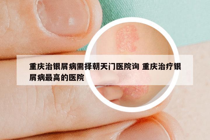 重庆治银屑病需择朝天门医院询 重庆治疗银屑病最高的医院